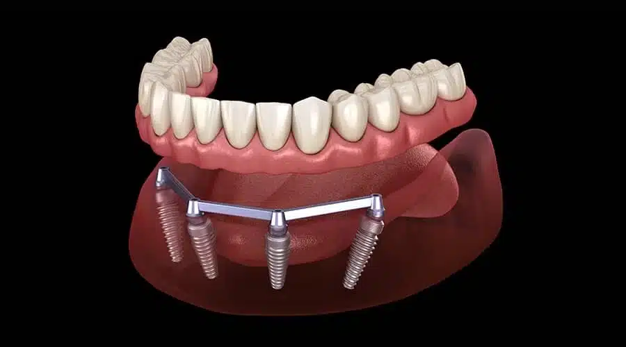 understanding about implant bar overdenture 