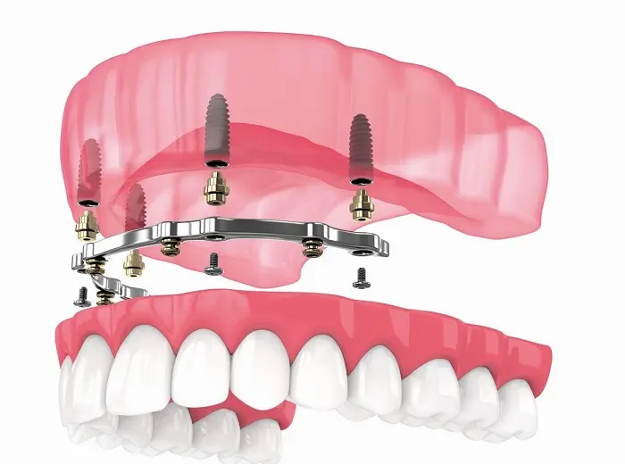 understanding-about-implant-bar-overdenture