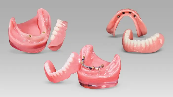 Understanding About Implant Bar Overdenture