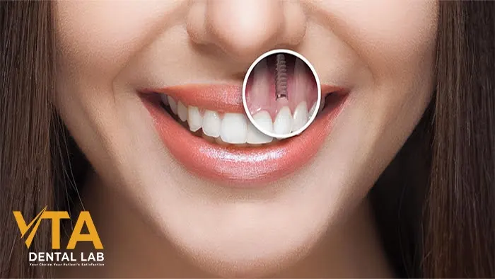 Anterior Implant: An Ordeal Dental Restoration