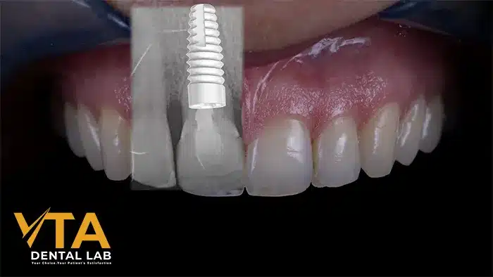 Anterior Implant: An Ordeal Dental Restoration For The Dentist