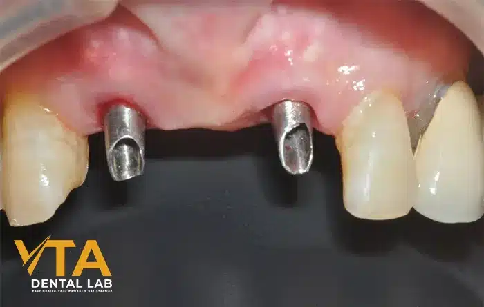 Anterior Implant: An Ordeal Dental Restoration For The Dentist