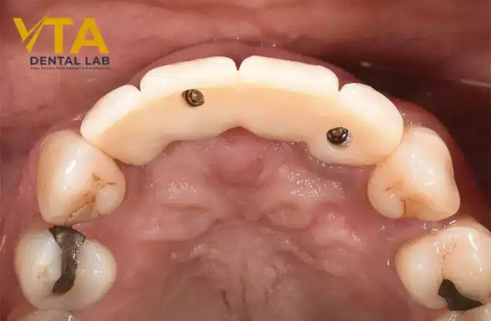 Anterior Implant: An Ordeal Dental Restoration 