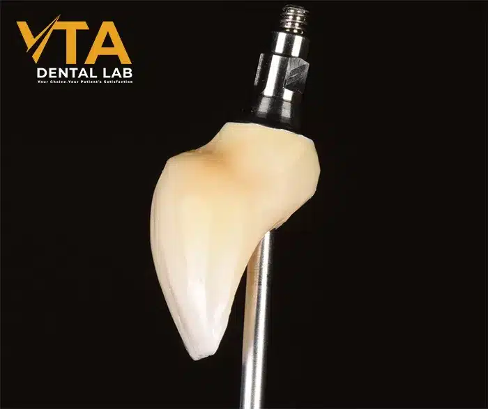 Anterior Implant: An Ordeal Dental Restoration 