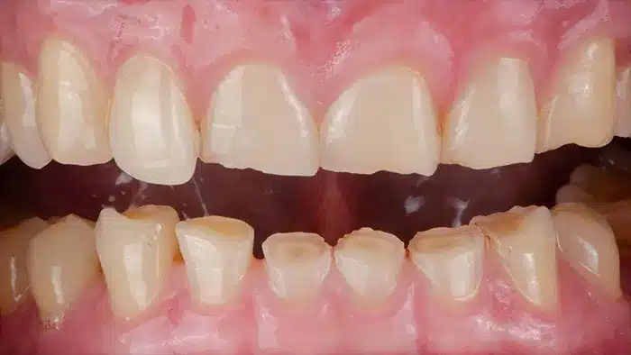 Bite Splints: Great Oral Protection Therapy 