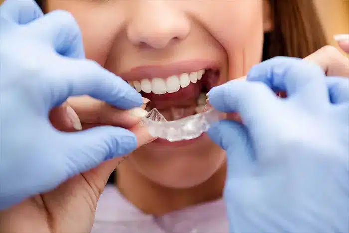 Bite Splints: Great Oral Protection Therapy 