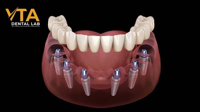 All on 6 dental implants: The Comprehensive Solution