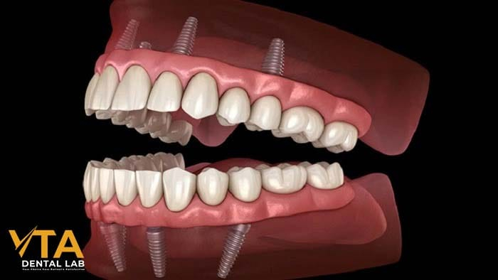 All on x dental implants: Who is a Candidate for?