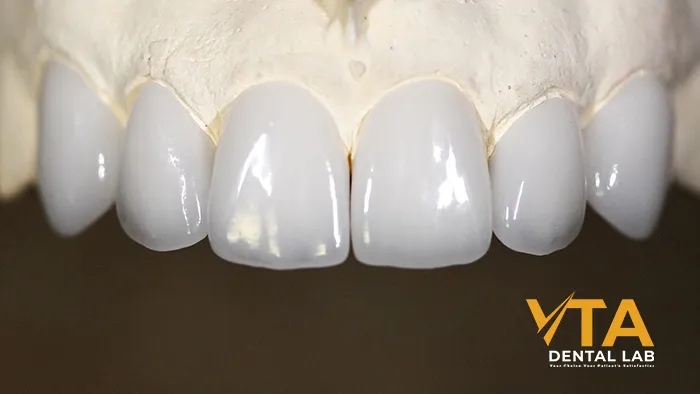 Anterior Crowns: Ultimate Instructive For Dentists