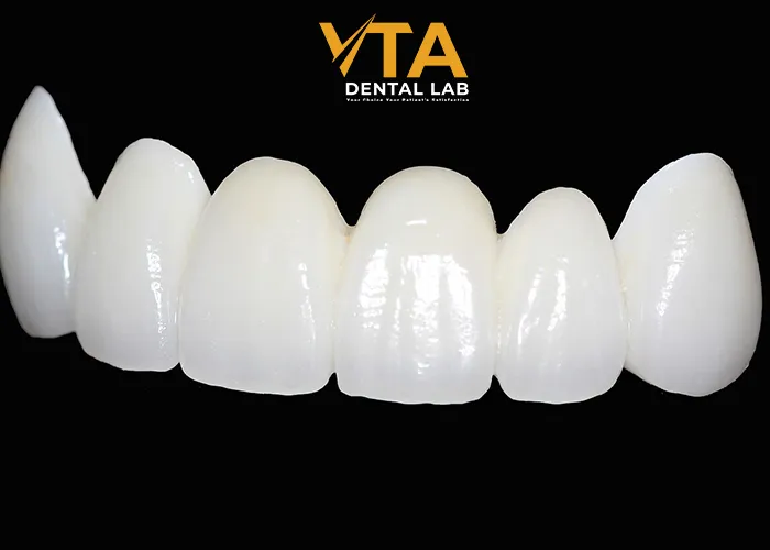 anterior-crown-ultimate-instructive-for-dentists