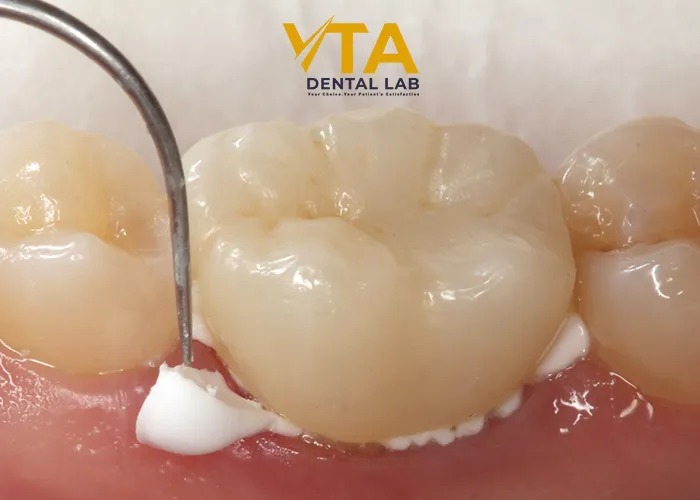 Cementing-Zirconia-Crowns-Decision-The-Success-Of-The-Workflow