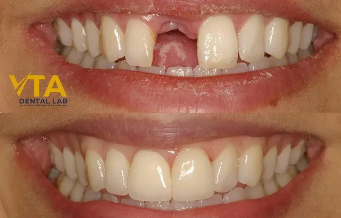 Accurate Understanding Of Anterior Bridge