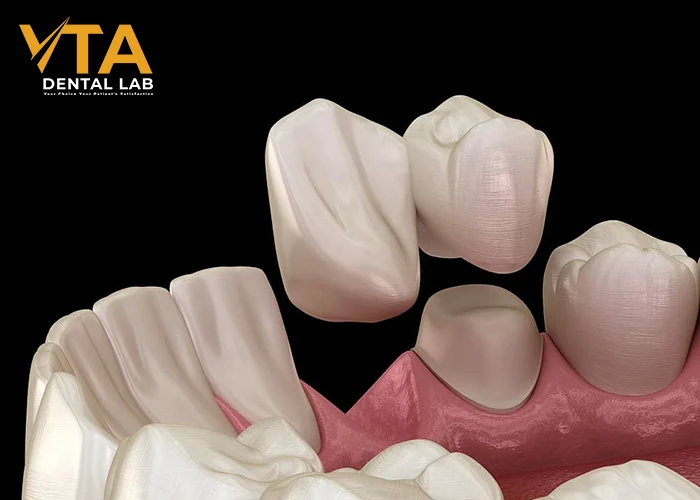 Accurate Understanding Of Anterior Bridge