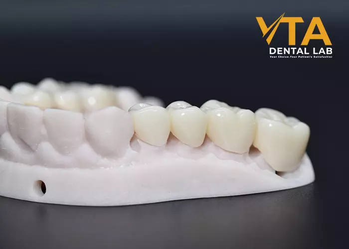 Dental Bridge And Implant: Which Is Better?