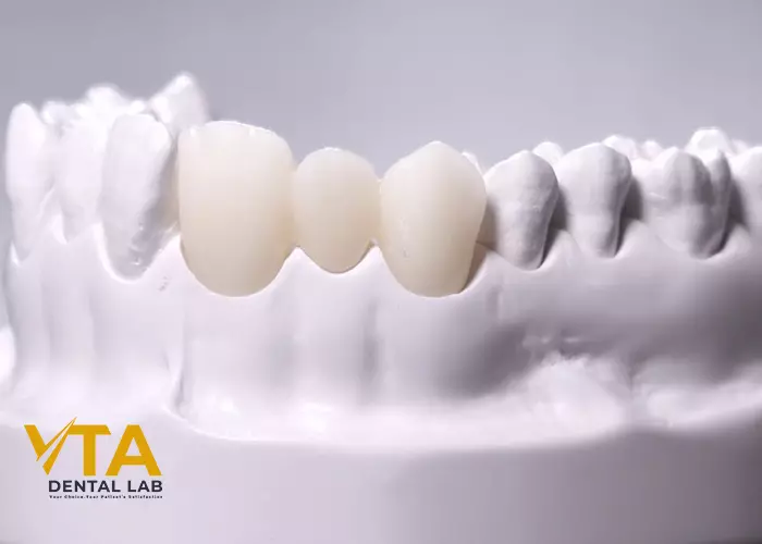 Dental Bridge And Implant: Which Is Better?