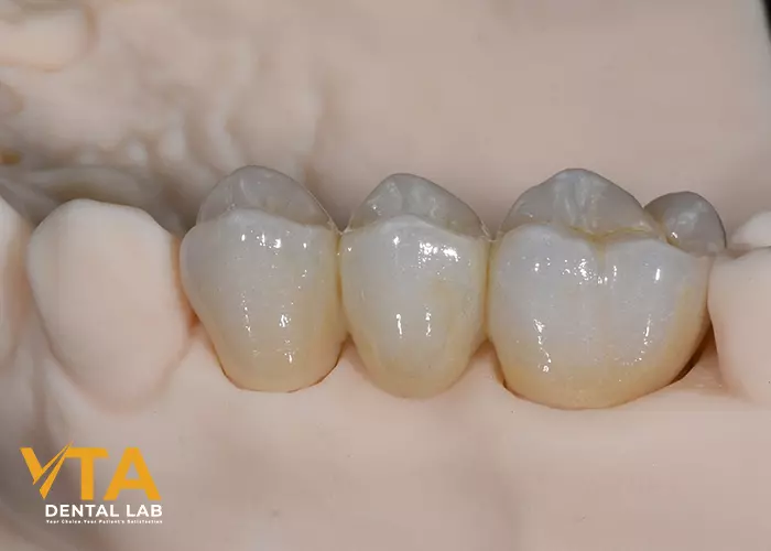 Dental Bridge And Implant: Which Is Better?