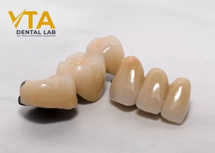 Dental Bridge And Implant: Which Is Better?