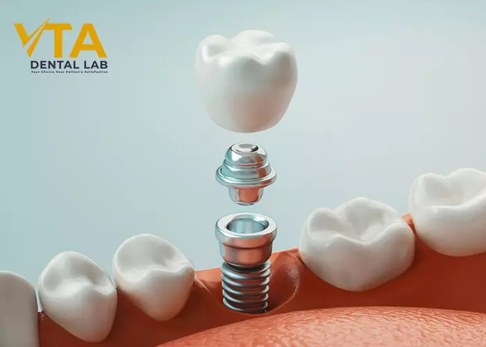 Dental Bridge And Implant: Which Is Better?