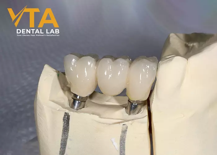 Dental Bridge And Implant: Which Is Better?