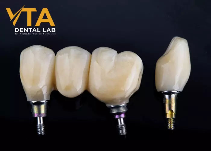 Dental Bridge And Implant: Which Is Better?