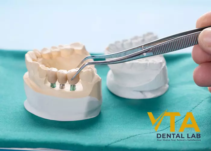 Dental Bridge And Implant: Which Is Better?