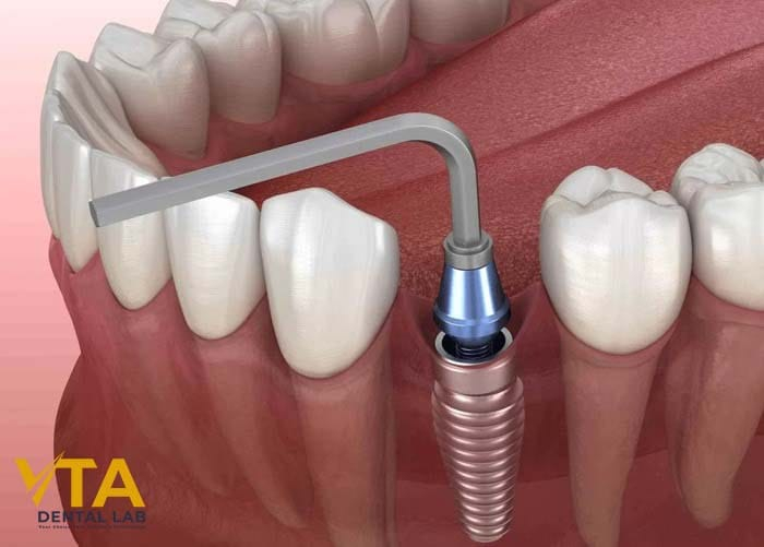 The dentist is surgically placing the dental implant into the jawbone