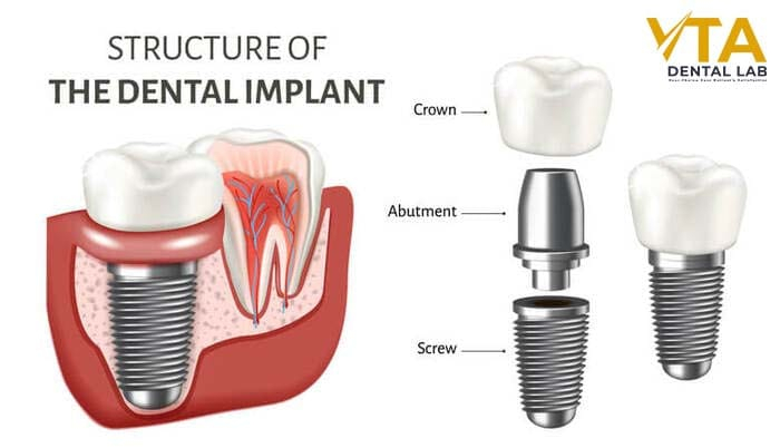 The Abutments for dental implants are made out of titanium or other materials