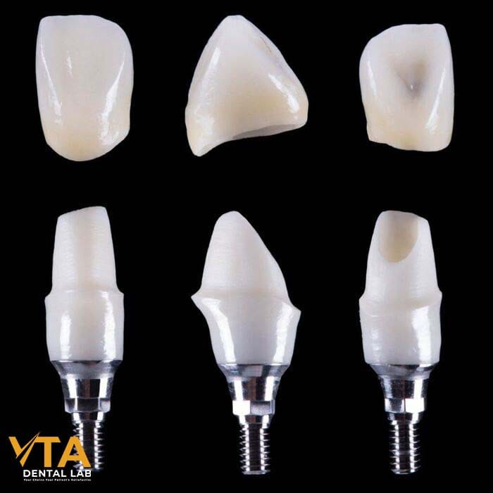 Zirconia abutments preferred in the anterior region for aesthetic purposes