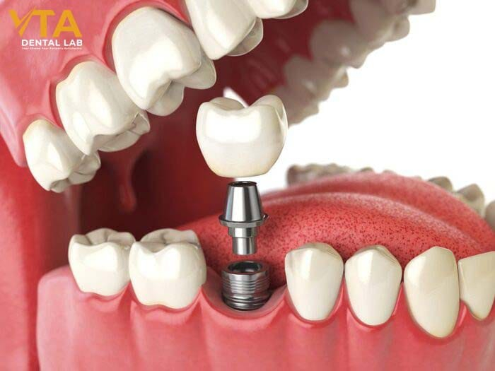 The cost of a dental implant depends on the location of the surgery.