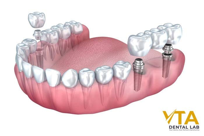 The Cost of a Multiple Tooth Implant