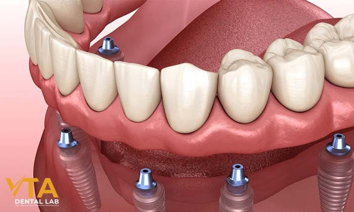 Dental implants can cost thousands of dollars 