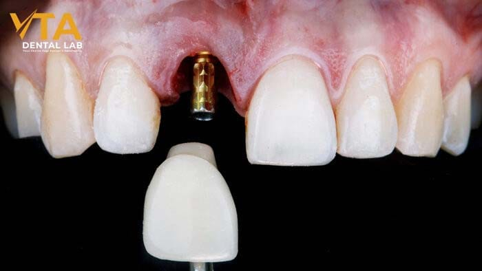 Discover the Long-Term Benefits of Dental Implants for Better Oral Health