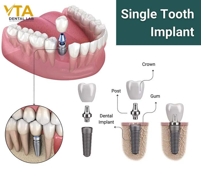 Dental implants are the best choice to replace lost teeth