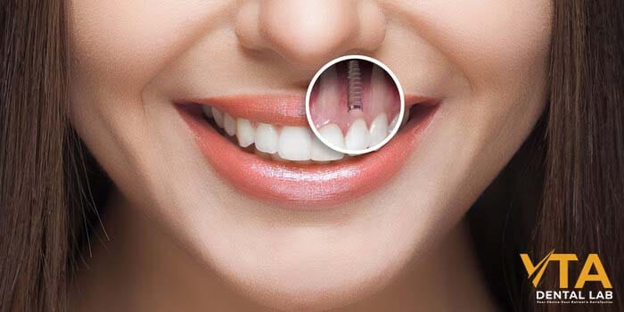 Dental implants bring a confident smile