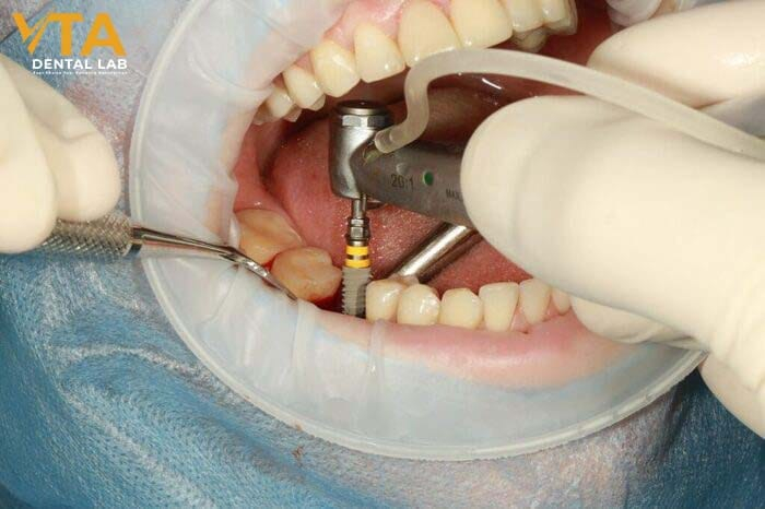 Dental implants can last a lifetime with proper oral hygiene and regular dental checkups