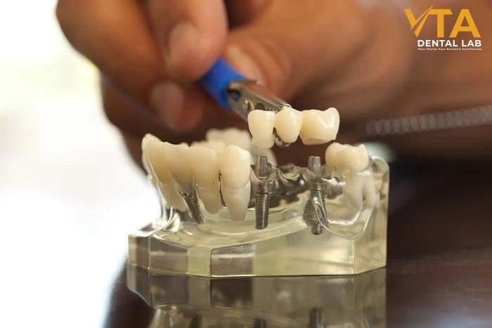 Dental implant insurance typically covers only a percentage of the total cost.