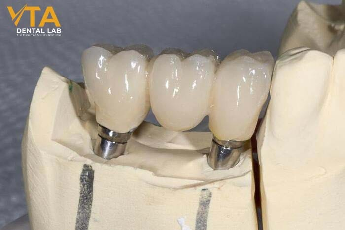 The ideal candicate for dental implants is one who is placing one or more missing teeth