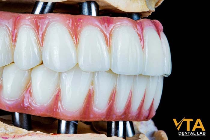 Patients with complete tooth loss can choose hybrid denture replacement