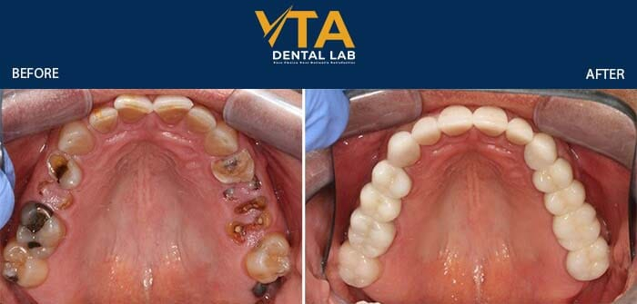 patients may need a bone grafting procedure before the placement of the dental implants