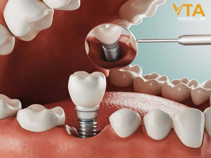 Dental implants help improve oral health effectively