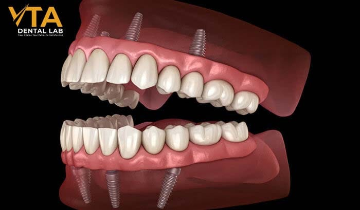 Bone grafting costs to consider when getting denture implants