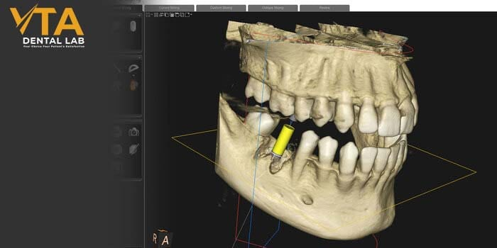 Technicians in the dental lab will craft the new dentures