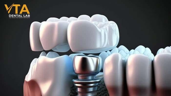 What is a Custom Abutment? Benefits and Technology Behind It