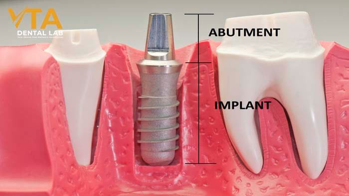 The Dental Abutment Placement Process: Steps to Success in Implant Dentistry