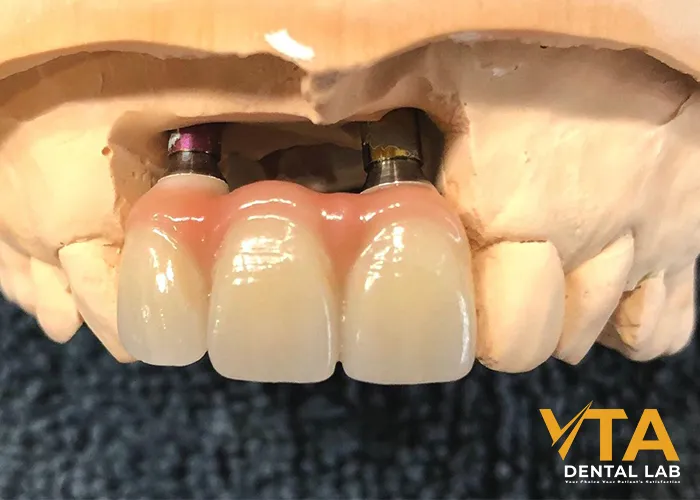 Implant Bridge For Front Teeth: The Wonderful Solution For High-End Aesthetic