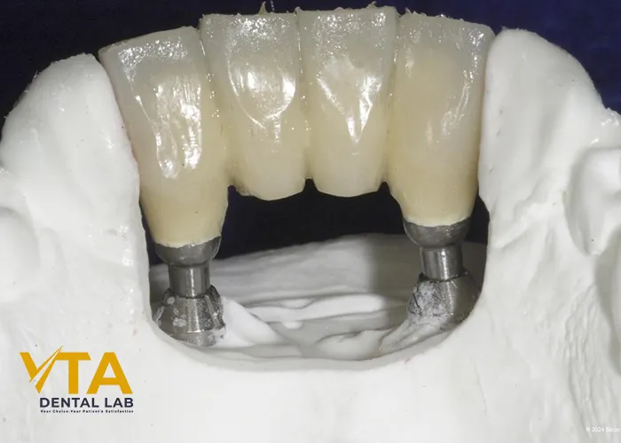 Implant Bridge For Front Teeth: The Wonderful Solution For High-End Aesthetic