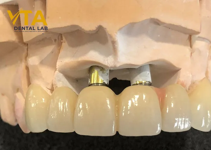 Implant Bridge For Front Teeth: The Wonderful Solution For High-End Aesthetic