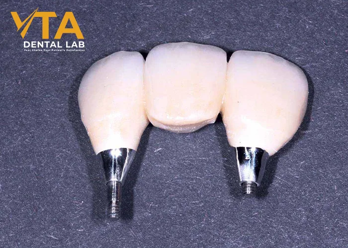 Implant Bridge For Front Teeth: The Wonderful Solution For High-End Aesthetic