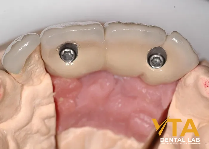 Implant Bridge For Front Teeth: The Wonderful Solution For High-End Aesthetic