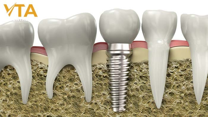 Dental Implants: A Lasting Solution for Tooth Replacement